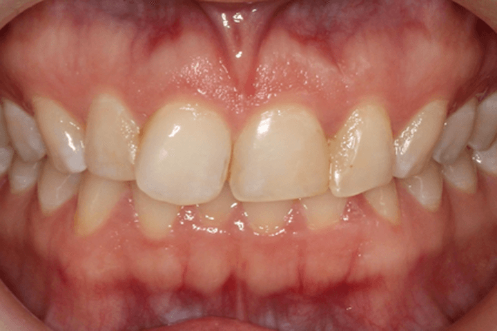 Before treatment: Adult patient