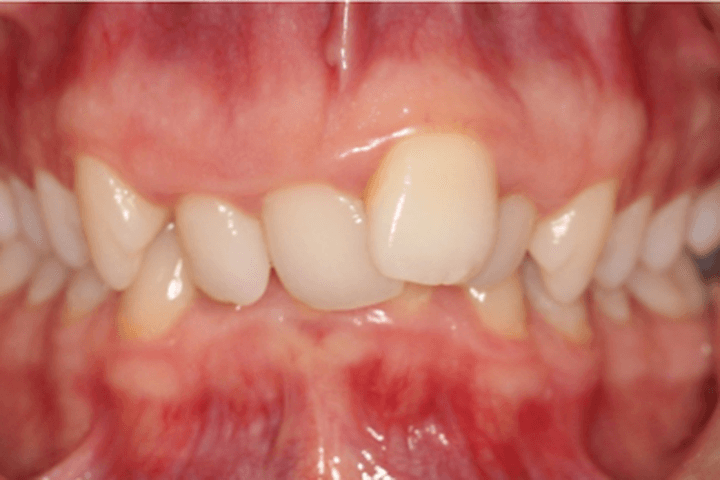 Before treatment: Crowding: case 1