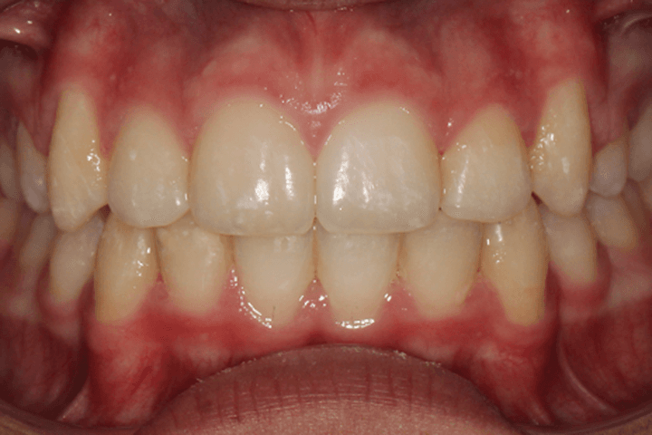 After treatment: Crowding: case 2