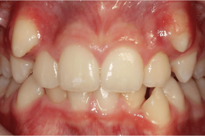 Before treatment: Crowding: case 2