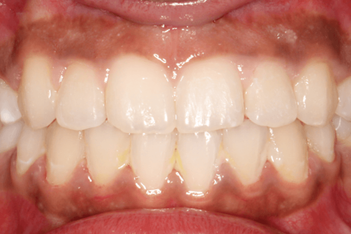 After treatment: Crowding: case 3
