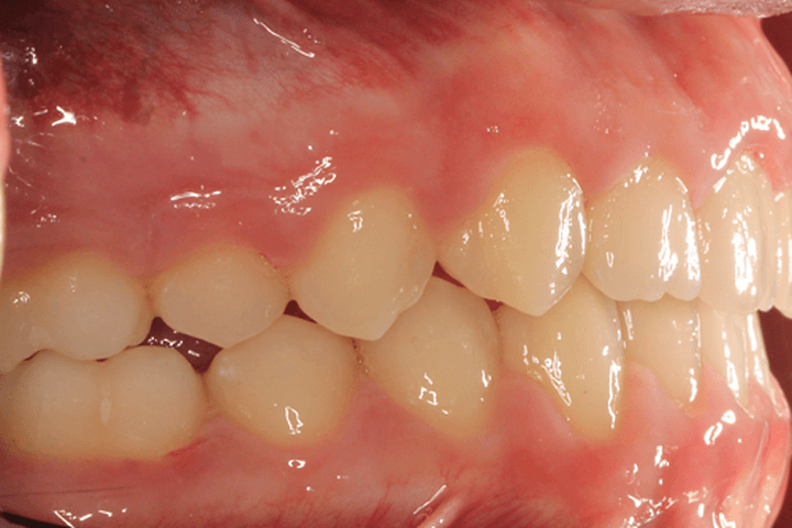 After treatment: Overbite