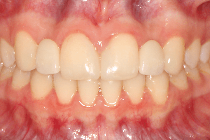 After treatment: Spacing: case 1