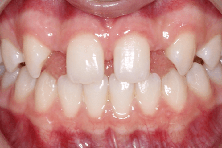 Before treatment: Spacing: case 1
