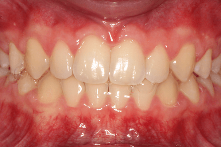 After treatment: Spacing: case 2